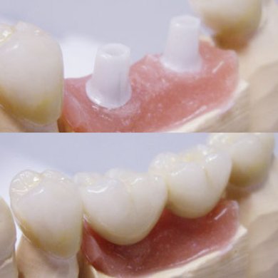 Implantattechnik