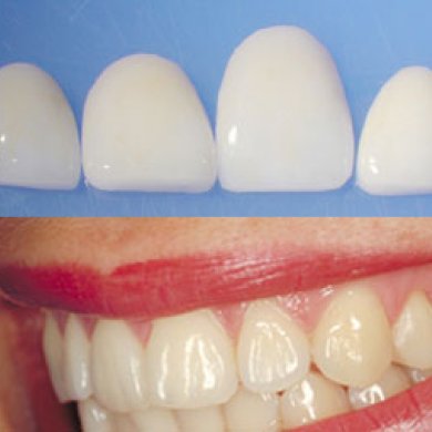 Veneers Veneers
